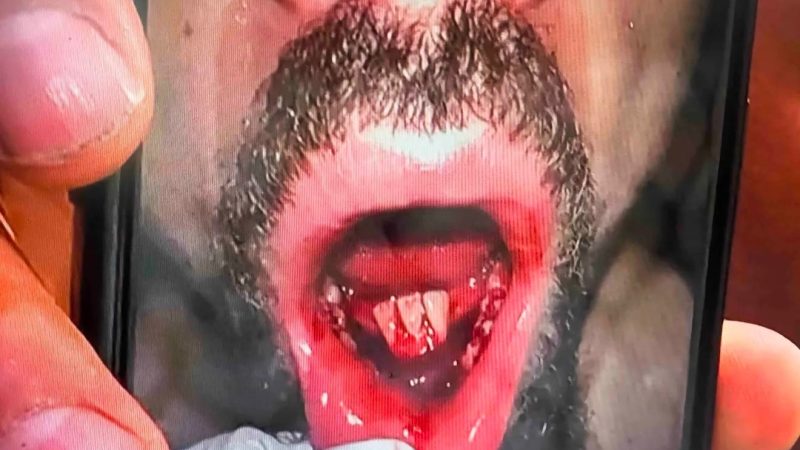Imagem forte: Chimaev quebra mandíbula de Whittaker no UFC 308