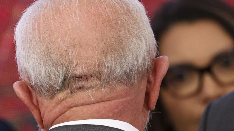 Cirurgia de Lula foi bem-sucedida e funções cerebrais estão intactas