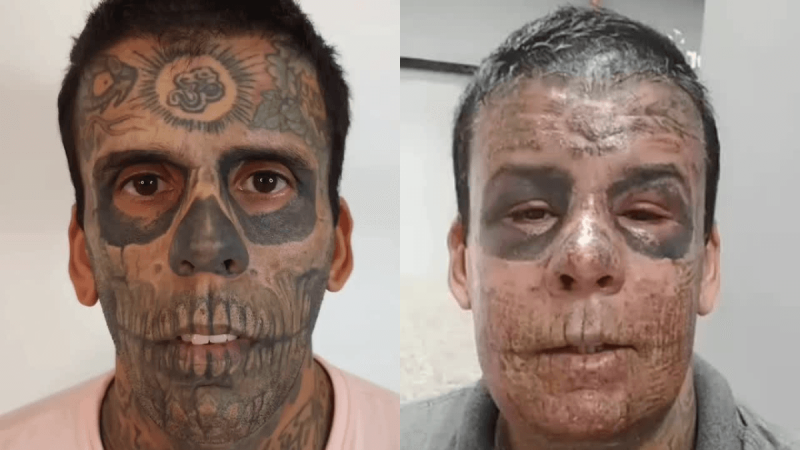 Homem mais tatuado do Brasil se converte e remove tatuagens do rosto