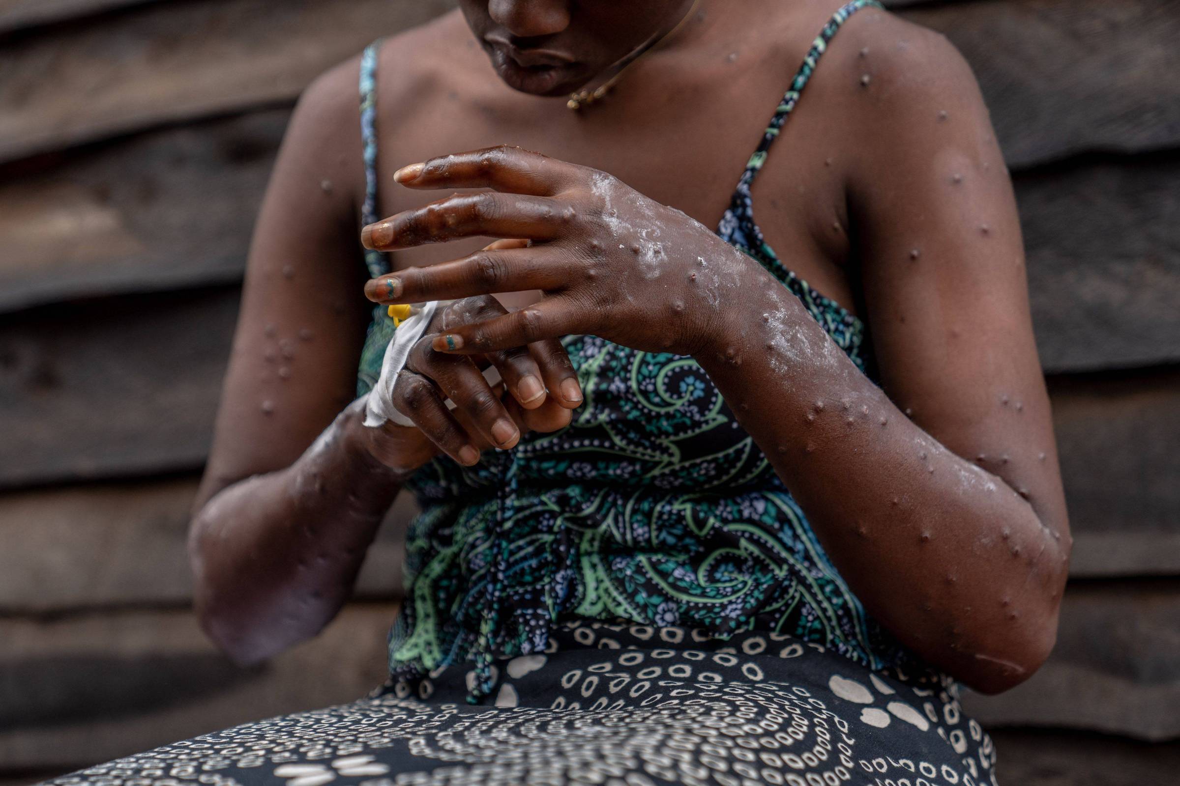 Buscas sobre mpox e calabreso crescem em 2024 – 10/12/2024 – Tec